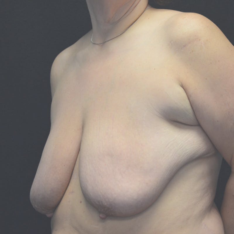 Breast Lift Before & After Gallery - Patient 114721032 - Image 7