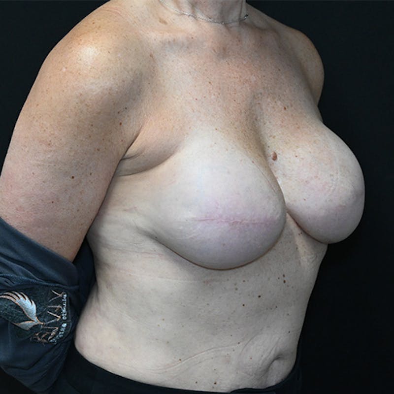 Breast Reconstruction Before & After Gallery - Patient 114721036 - Image 4