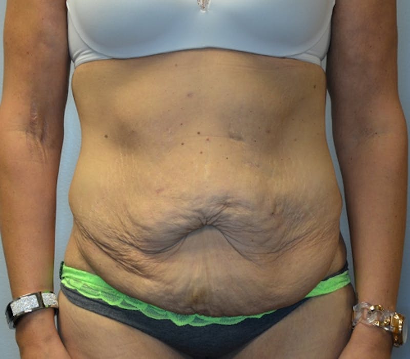 Abdominoplasty (Tummy Tuck) Before & After Gallery - Patient 114721039 - Image 1