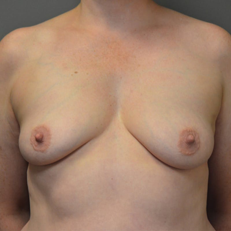 Breast Augmentation with Lift Before & After Gallery - Patient 114721040 - Image 1