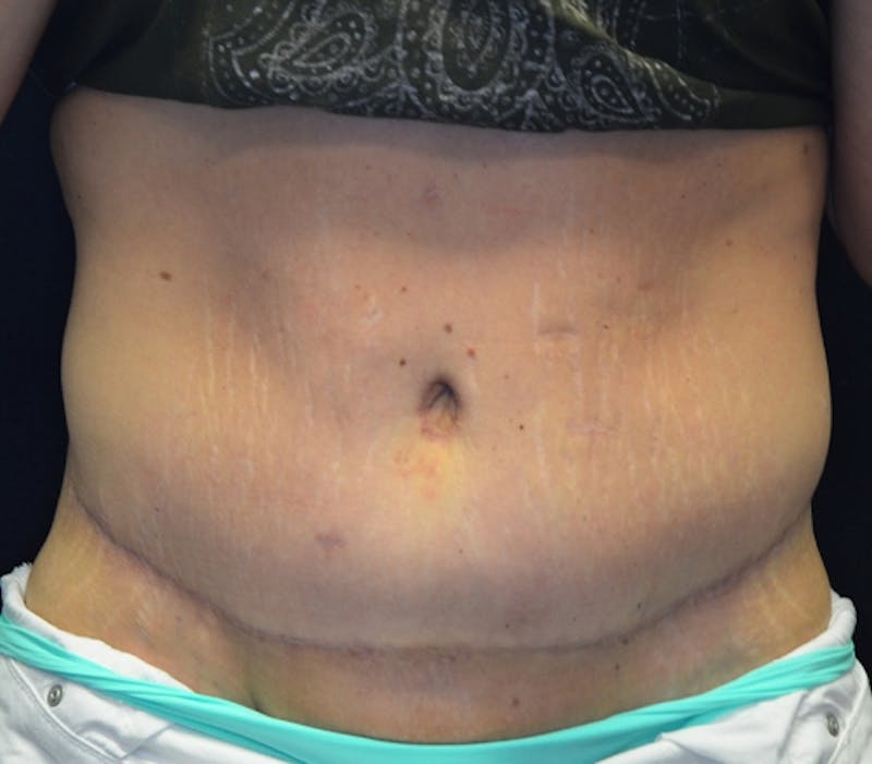 Abdominoplasty (Tummy Tuck) Before & After Gallery - Patient 114721039 - Image 2