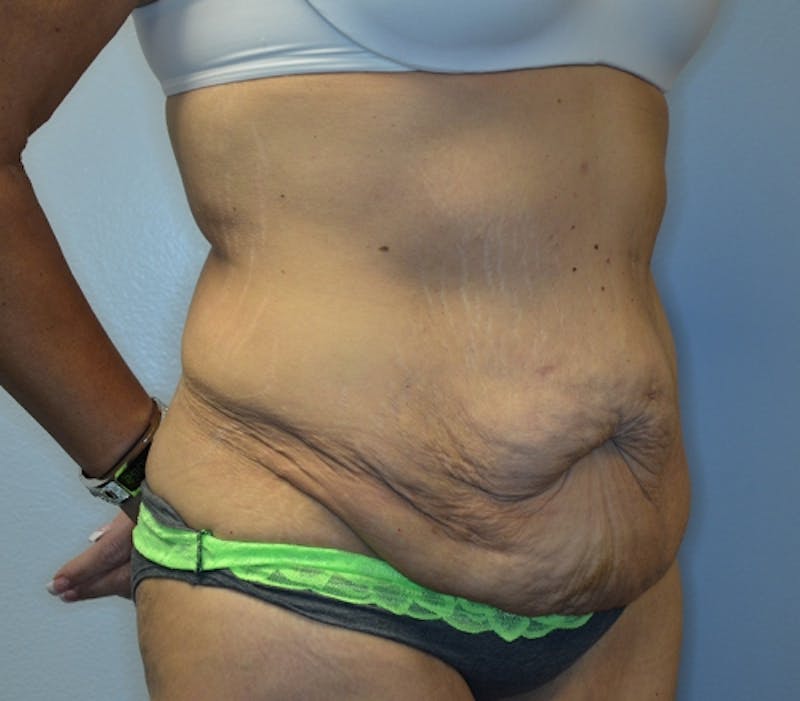 Abdominoplasty (Tummy Tuck) Before & After Gallery - Patient 114721039 - Image 3