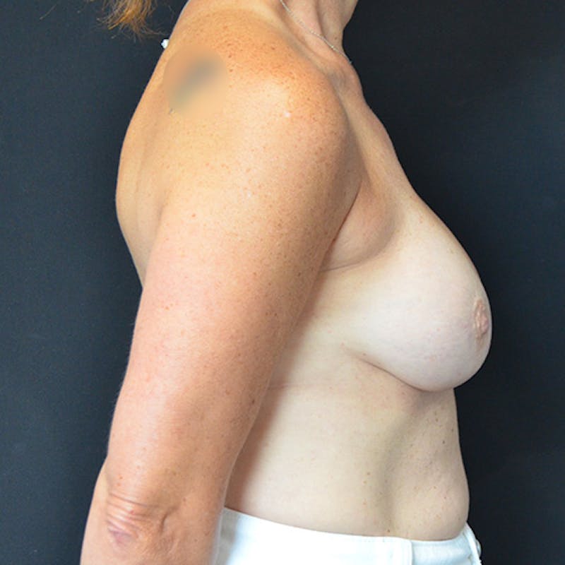 Breast Reconstruction Before & After Gallery - Patient 114721036 - Image 7