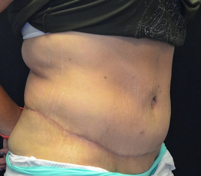 Abdominoplasty (Tummy Tuck) Before & After Gallery - Patient 114721039 - Image 4