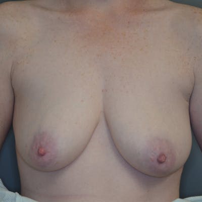 Breast Lift Before & After Gallery - Patient 114721042 - Image 1
