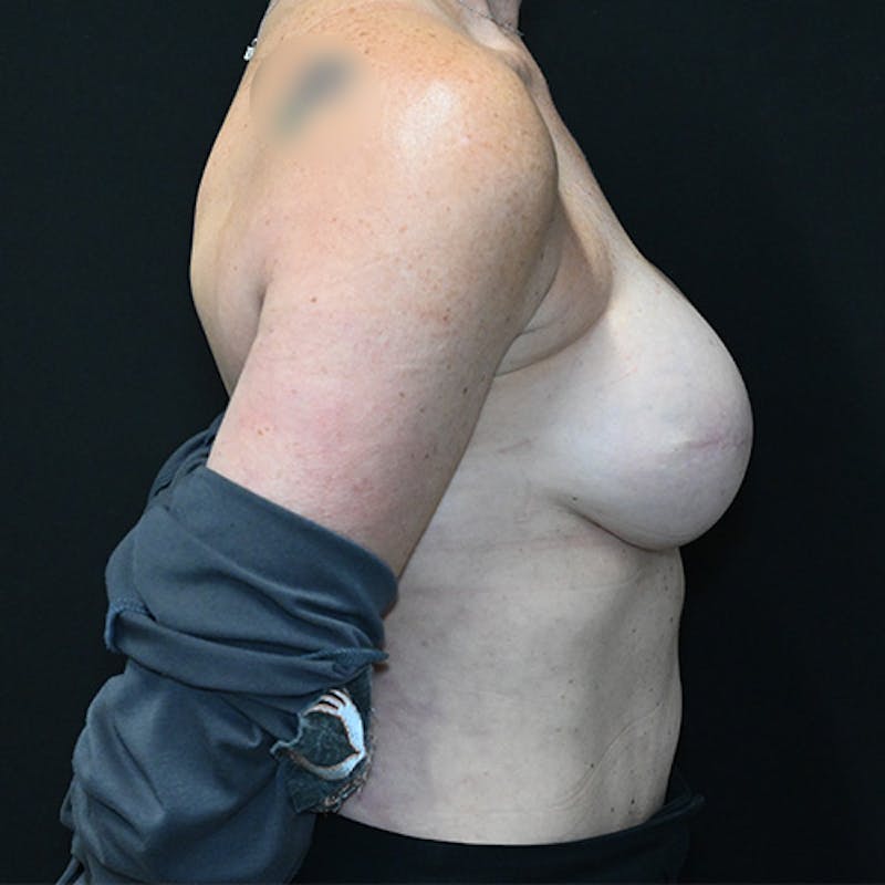 Breast Reconstruction Before & After Gallery - Patient 114721036 - Image 8