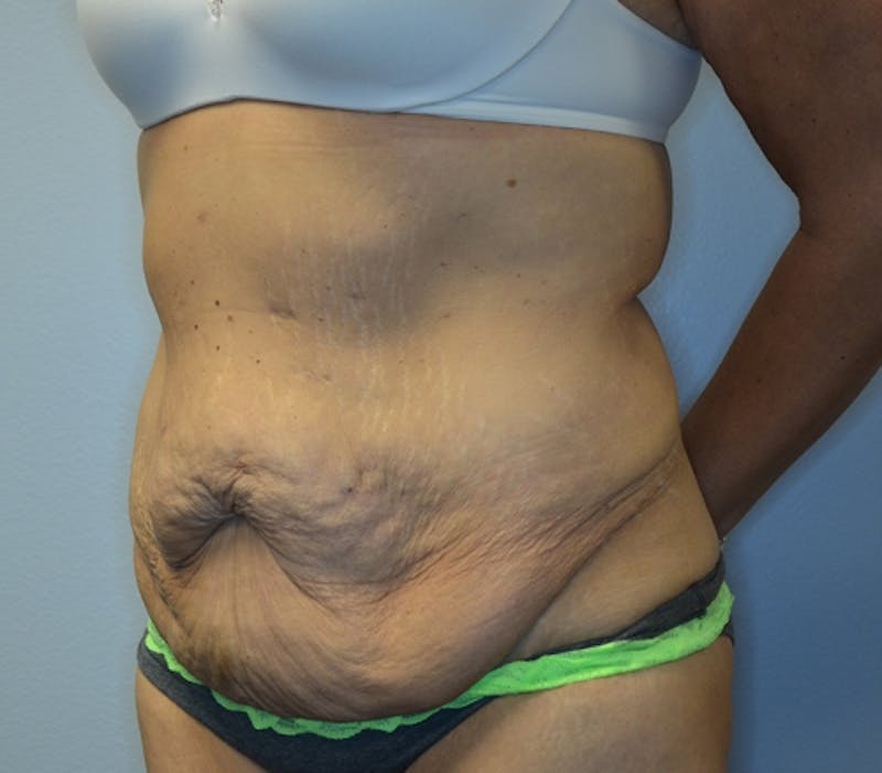 Abdominoplasty (Tummy Tuck) Before & After Gallery - Patient 114721039 - Image 5