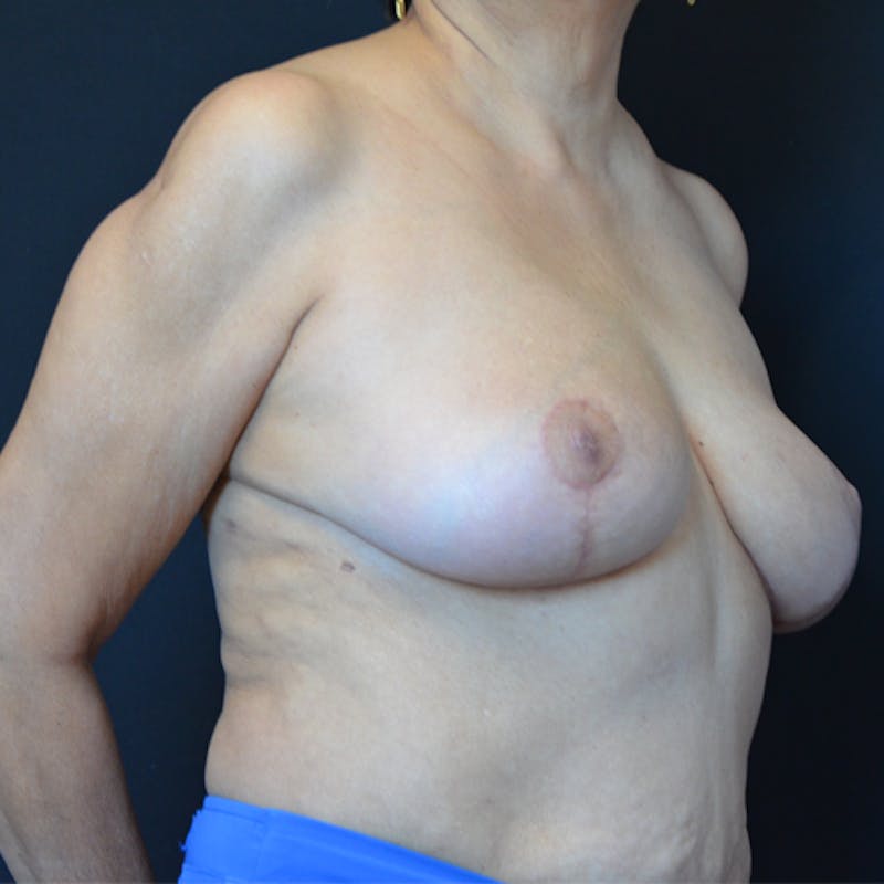 Breast Reduction Before & After Gallery - Patient 114721035 - Image 10