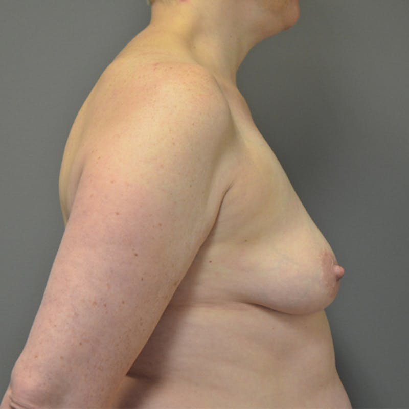 Breast Augmentation with Lift Before & After Gallery - Patient 114721040 - Image 5