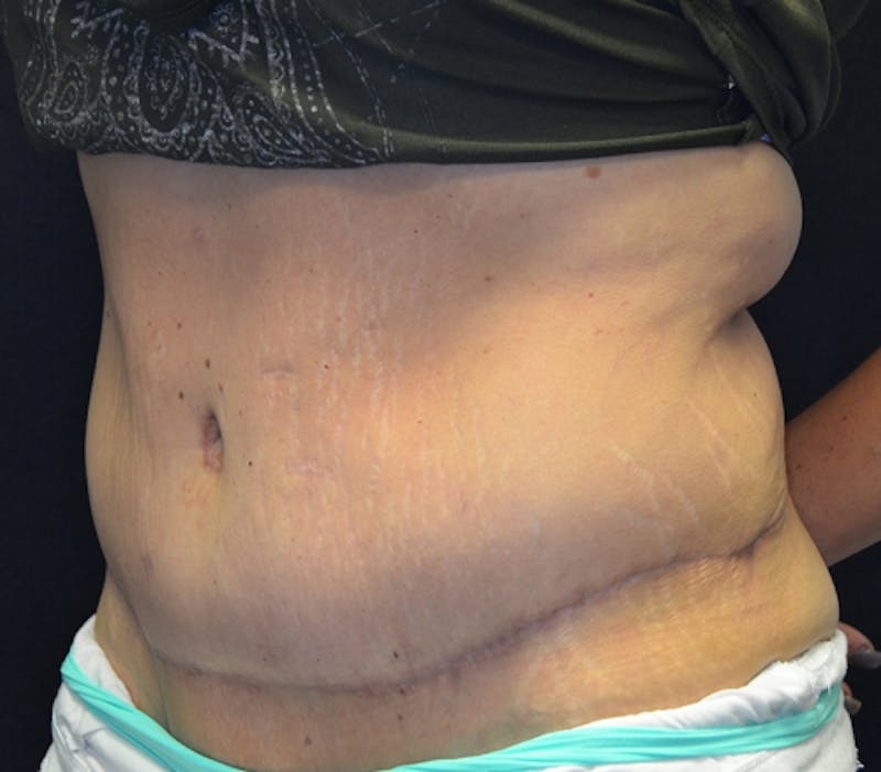 Abdominoplasty (Tummy Tuck) Before & After Gallery - Patient 114721039 - Image 6