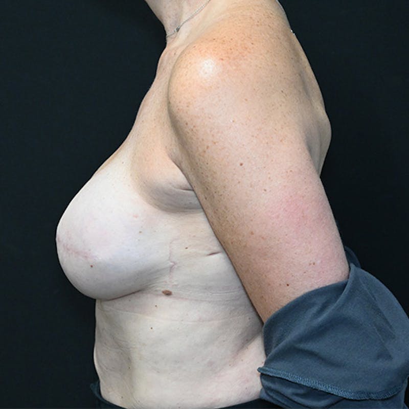 Breast Reconstruction Before & After Gallery - Patient 114721036 - Image 10