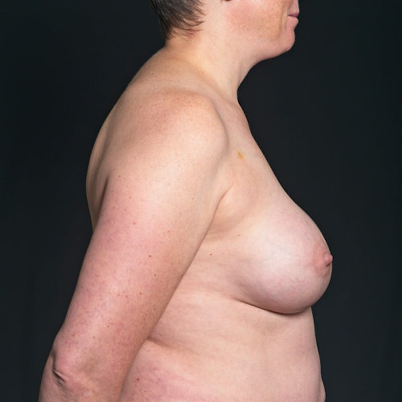Breast Augmentation with Lift Before & After Gallery - Patient 114721040 - Image 6