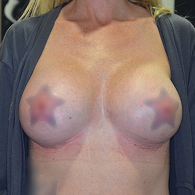 Breast Augmentation Before & After Gallery - Patient 114721037 - Image 2