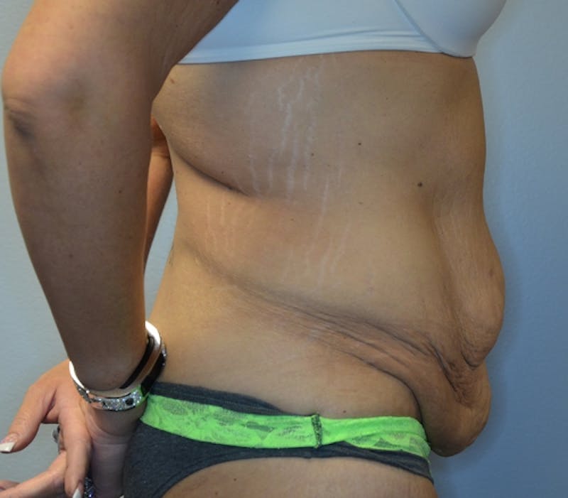 Abdominoplasty (Tummy Tuck) Before & After Gallery - Patient 114721039 - Image 7