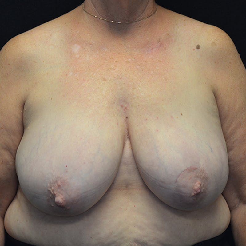 Breast Reconstruction Before & After Gallery - Patient 114721044 - Image 1