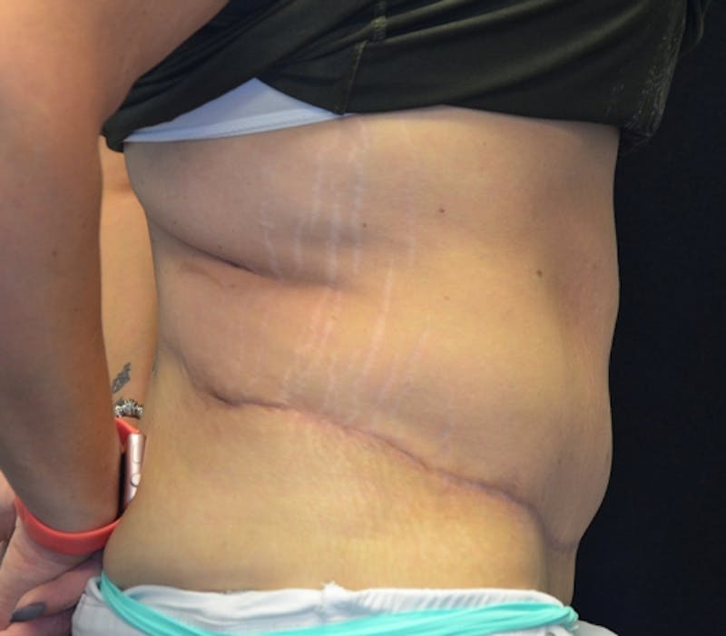 Abdominoplasty (Tummy Tuck) Before & After Gallery - Patient 114721039 - Image 8