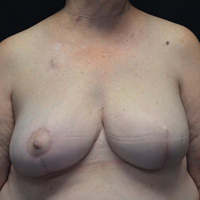 Breast Reconstruction Before & After Gallery - Patient 114721044 - Image 2