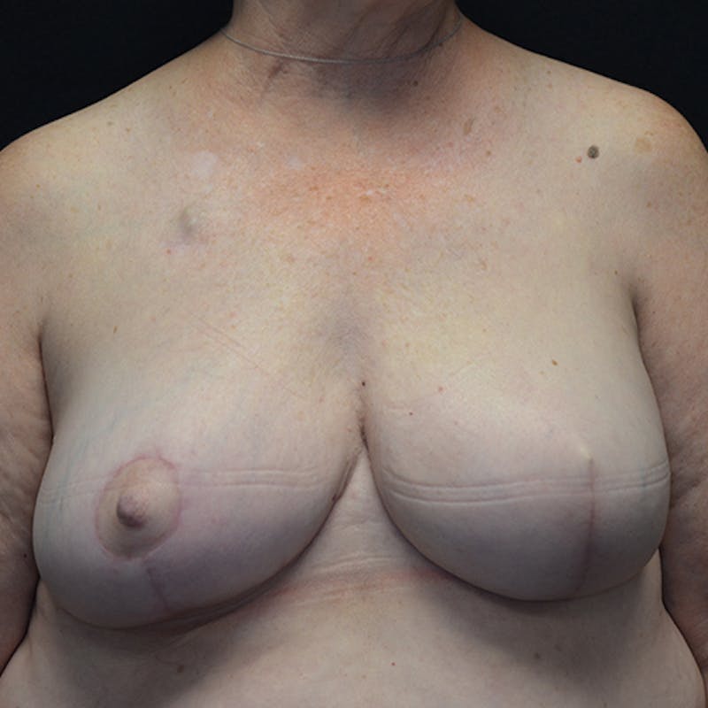 Breast Reconstruction Before & After Gallery - Patient 114721044 - Image 2