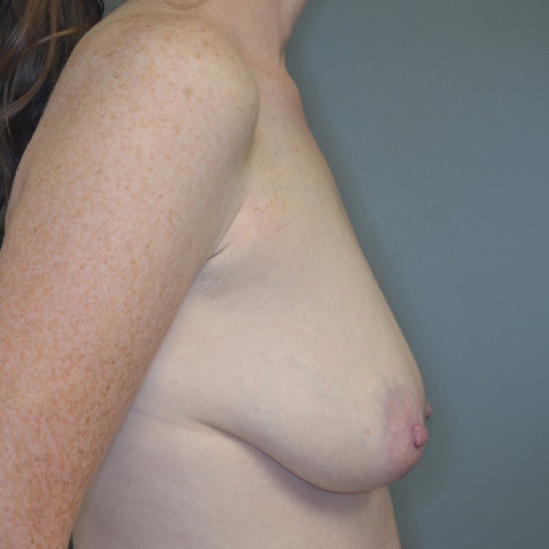Breast Lift Before & After Gallery - Patient 114721042 - Image 5