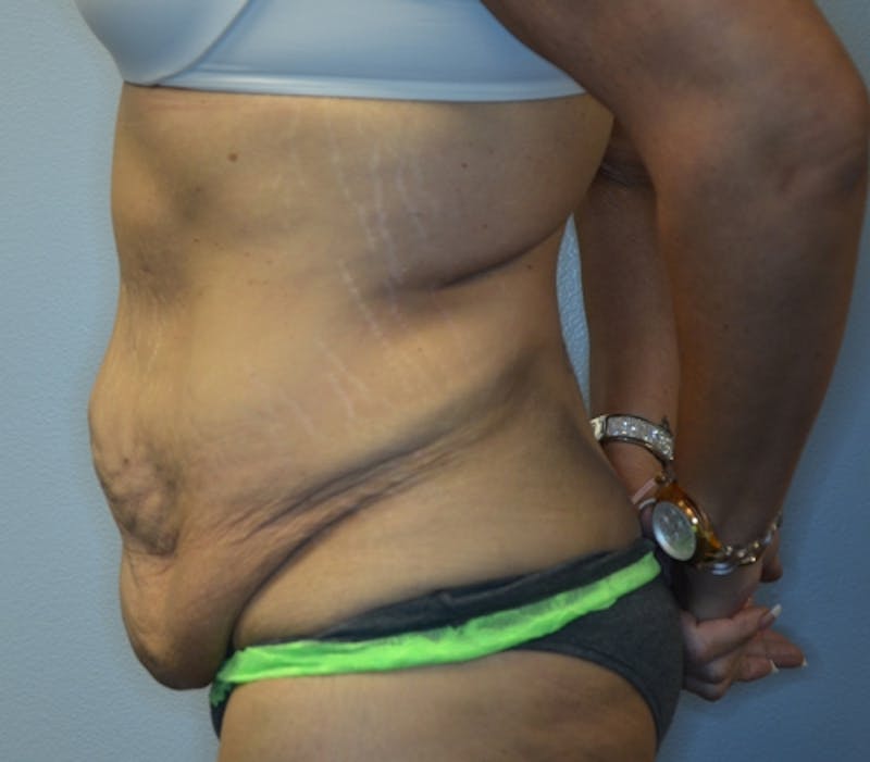 Abdominoplasty (Tummy Tuck) Before & After Gallery - Patient 114721039 - Image 9