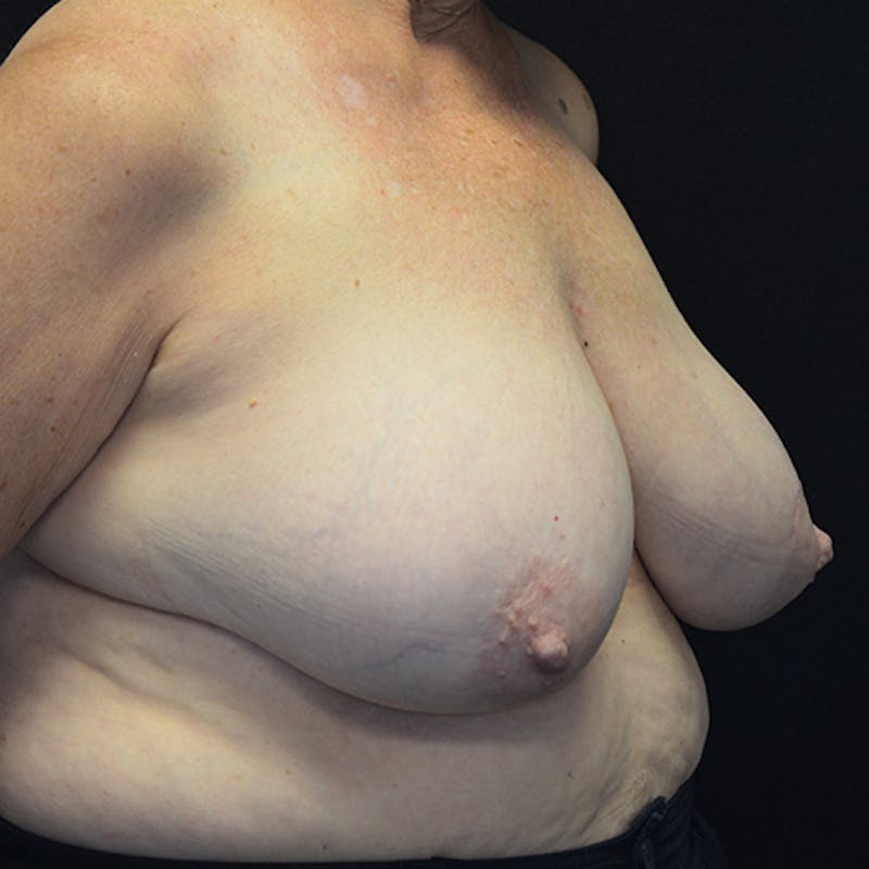 Breast Reconstruction Before & After Gallery - Patient 114721044 - Image 3