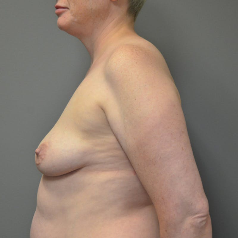 Breast Augmentation with Lift Before & After Gallery - Patient 114721040 - Image 9