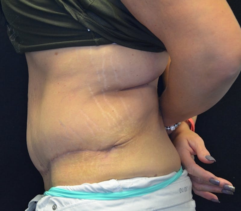 Abdominoplasty (Tummy Tuck) Before & After Gallery - Patient 114721039 - Image 10