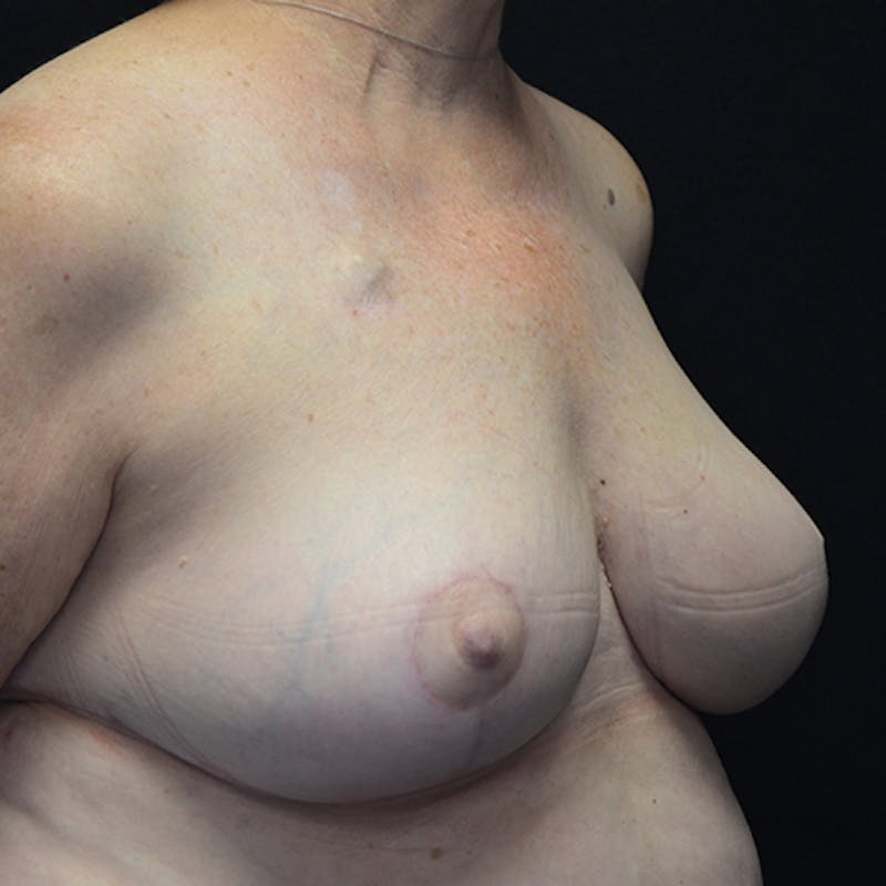 Breast Reconstruction Before & After Gallery - Patient 114721044 - Image 4