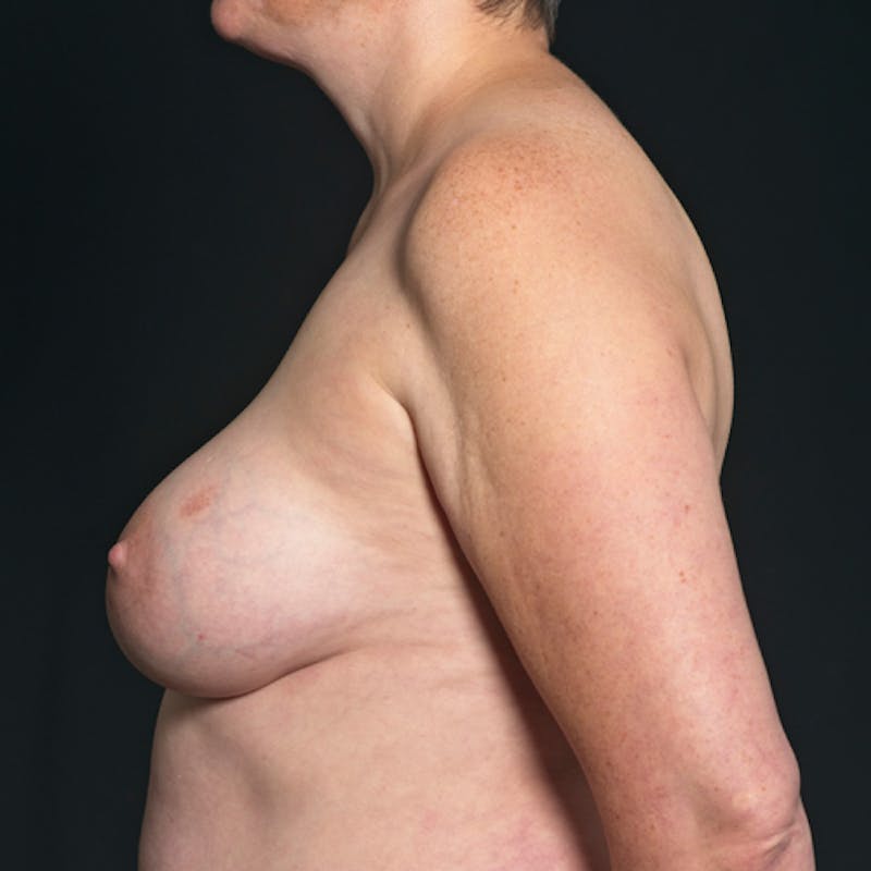 Breast Augmentation with Lift Before & After Gallery - Patient 114721040 - Image 10