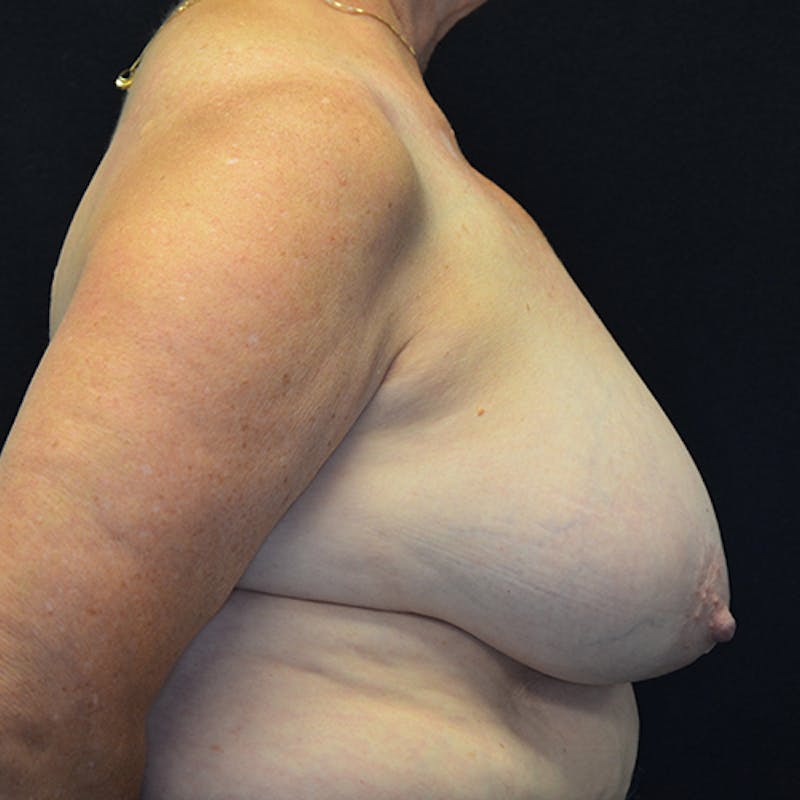 Breast Reconstruction Before & After Gallery - Patient 114721044 - Image 5