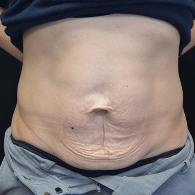 Abdominoplasty (Tummy Tuck) Before & After Gallery - Patient 114721049 - Image 1