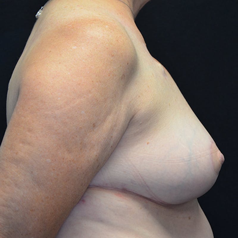 Breast Reconstruction Before & After Gallery - Patient 114721044 - Image 6