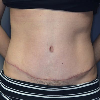 Abdominoplasty (Tummy Tuck) Before & After Gallery - Patient 114721049 - Image 2