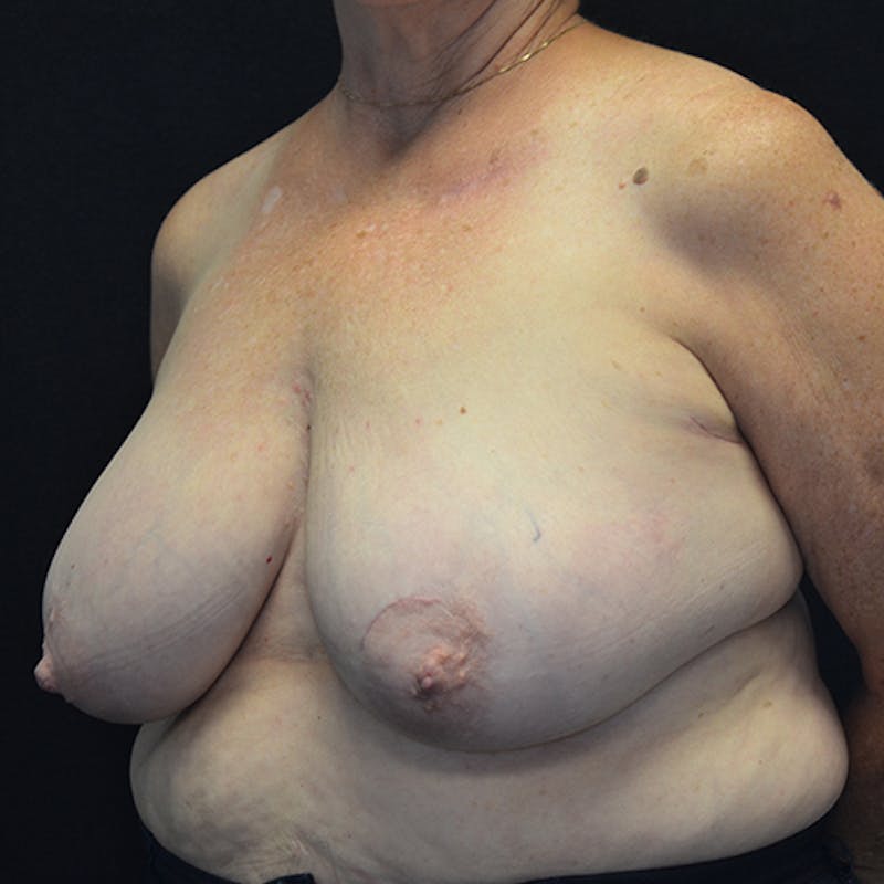 Breast Reconstruction Before & After Gallery - Patient 114721044 - Image 7