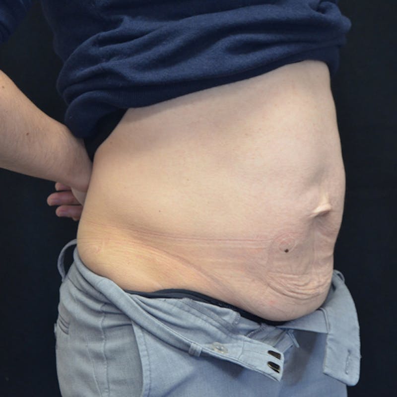 Abdominoplasty (Tummy Tuck) Before & After Gallery - Patient 114721049 - Image 3