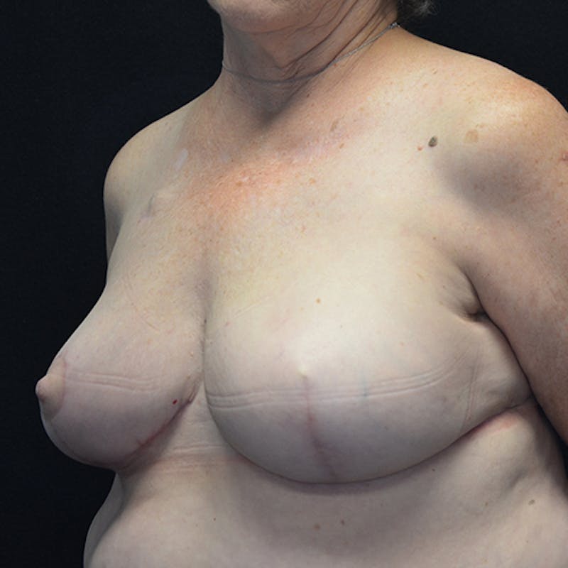 Breast Reconstruction Before & After Gallery - Patient 114721044 - Image 8
