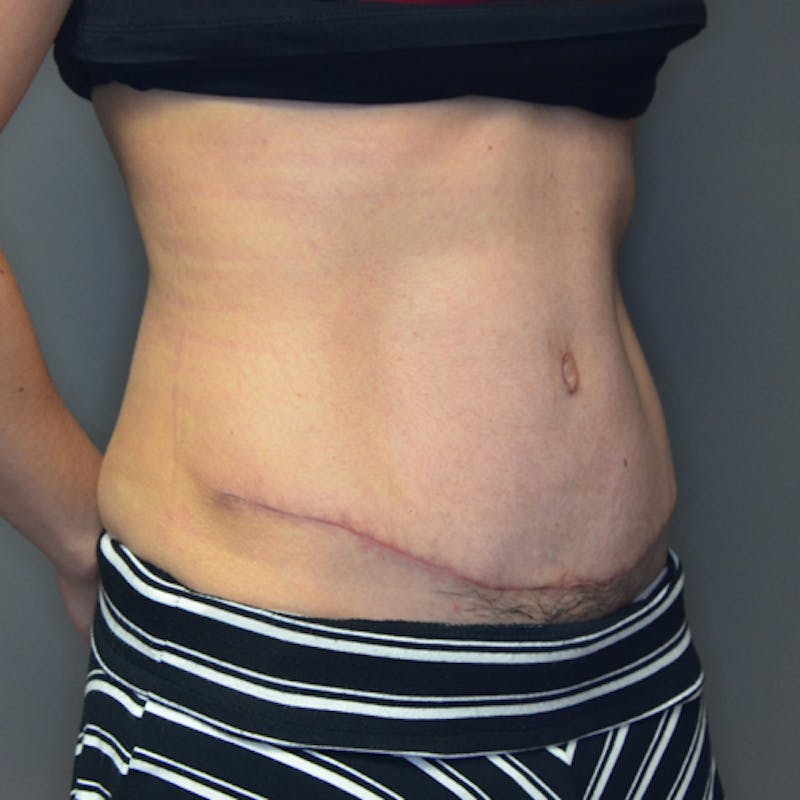 Abdominoplasty (Tummy Tuck) Before & After Gallery - Patient 114721049 - Image 4