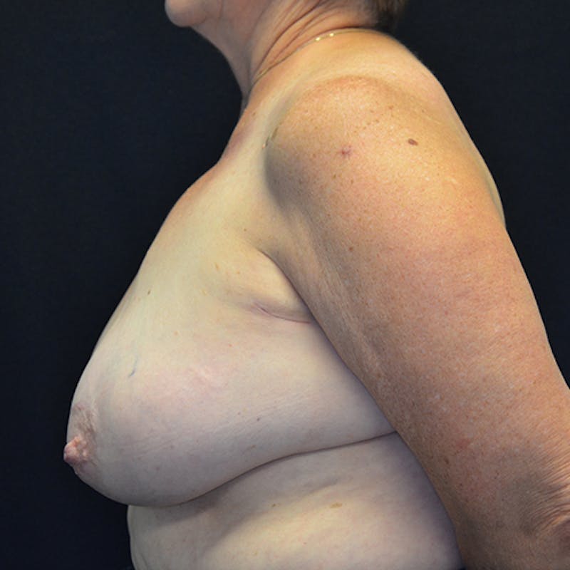 Breast Reconstruction Before & After Gallery - Patient 114721044 - Image 9