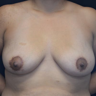 Breast Lift Before & After Gallery - Patient 114721050 - Image 2