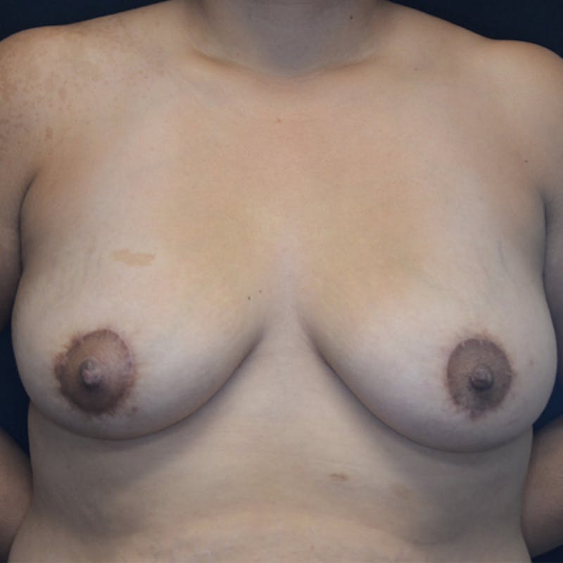 Breast Lift Before & After Gallery - Patient 114721050 - Image 2