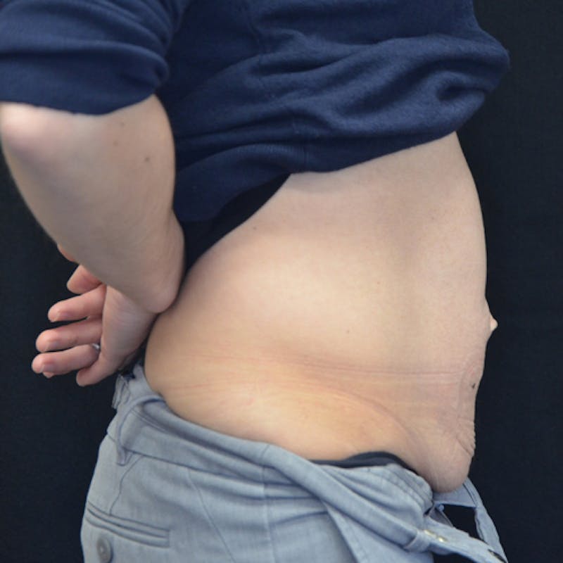 Abdominoplasty (Tummy Tuck) Before & After Gallery - Patient 114721049 - Image 5