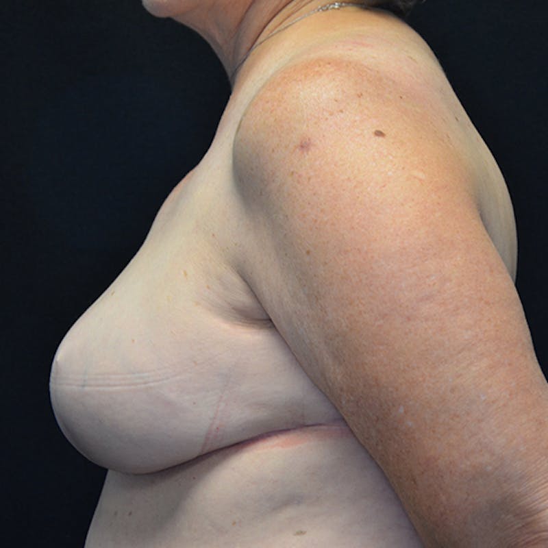 Breast Reconstruction Before & After Gallery - Patient 114721044 - Image 10
