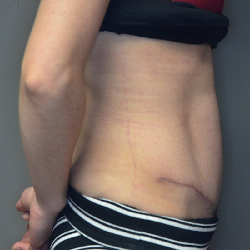 Abdominoplasty (Tummy Tuck) Before & After Gallery - Patient 114721049 - Image 6