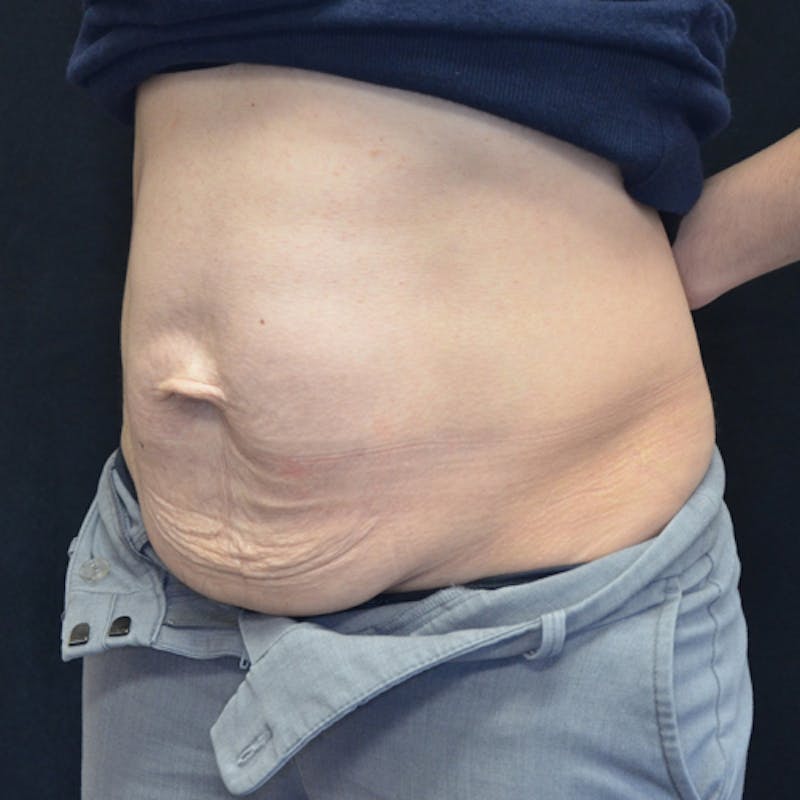 Abdominoplasty (Tummy Tuck) Before & After Gallery - Patient 114721049 - Image 7
