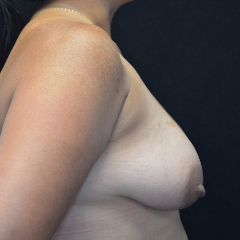 Breast Lift Before & After Gallery - Patient 114721050 - Image 5
