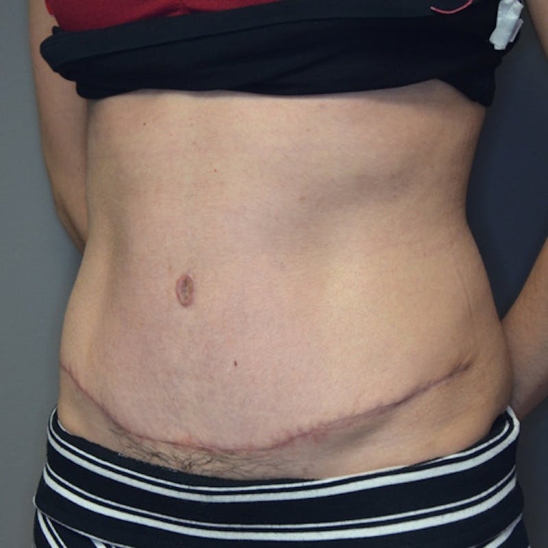 Abdominoplasty (Tummy Tuck) Before & After Gallery - Patient 114721049 - Image 8