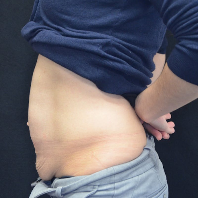 Abdominoplasty (Tummy Tuck) Before & After Gallery - Patient 114721049 - Image 9