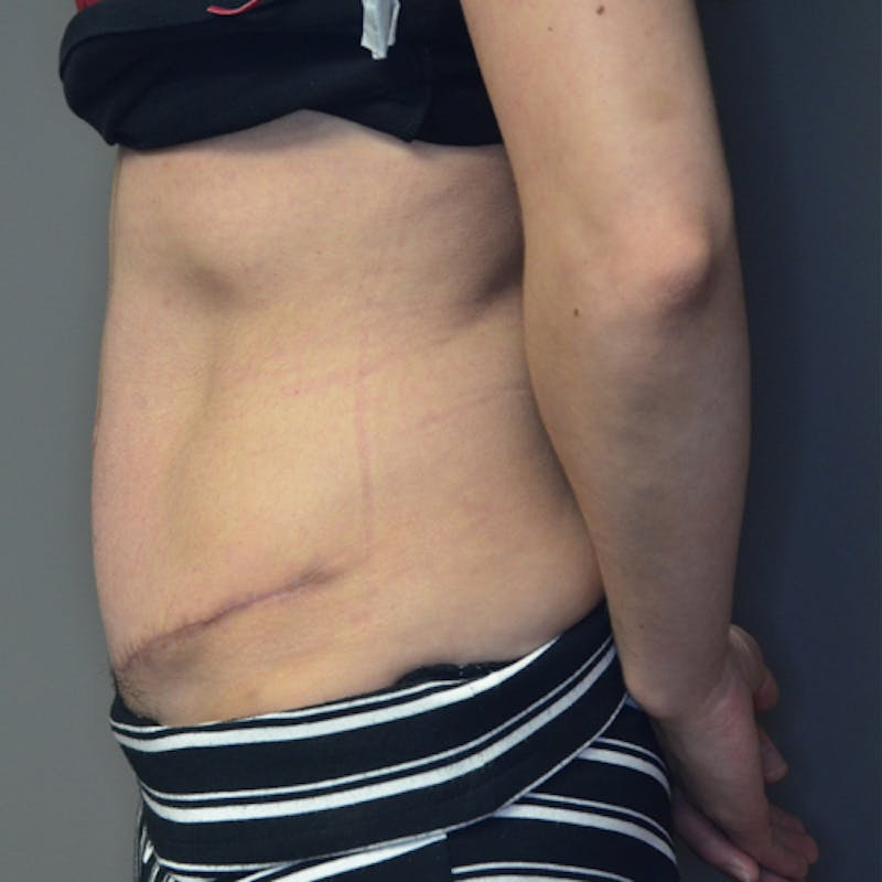 Abdominoplasty (Tummy Tuck) Before & After Gallery - Patient 114721049 - Image 10