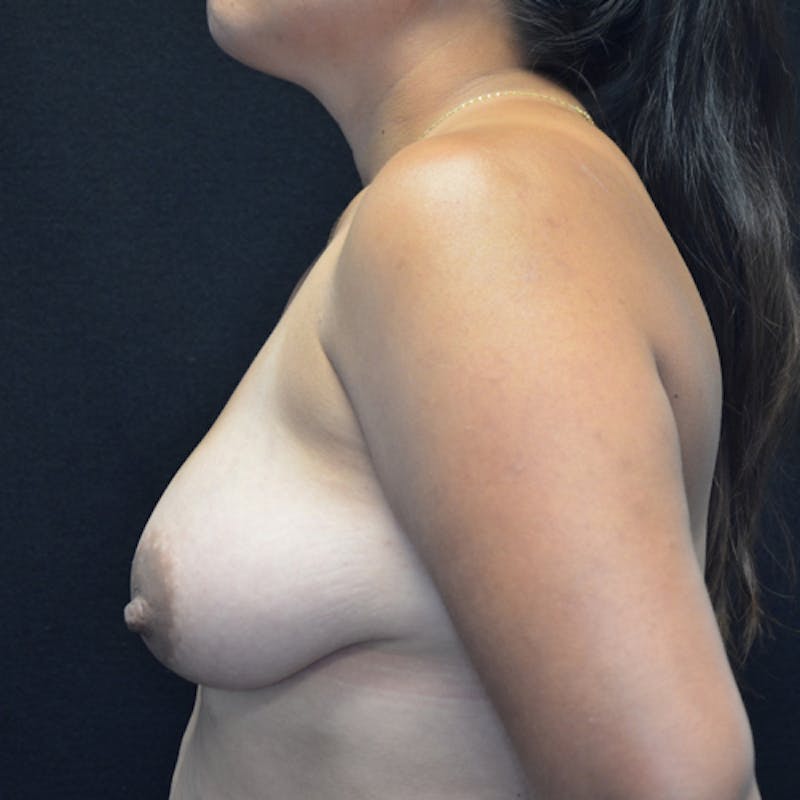 Breast Lift Before & After Gallery - Patient 114721050 - Image 9