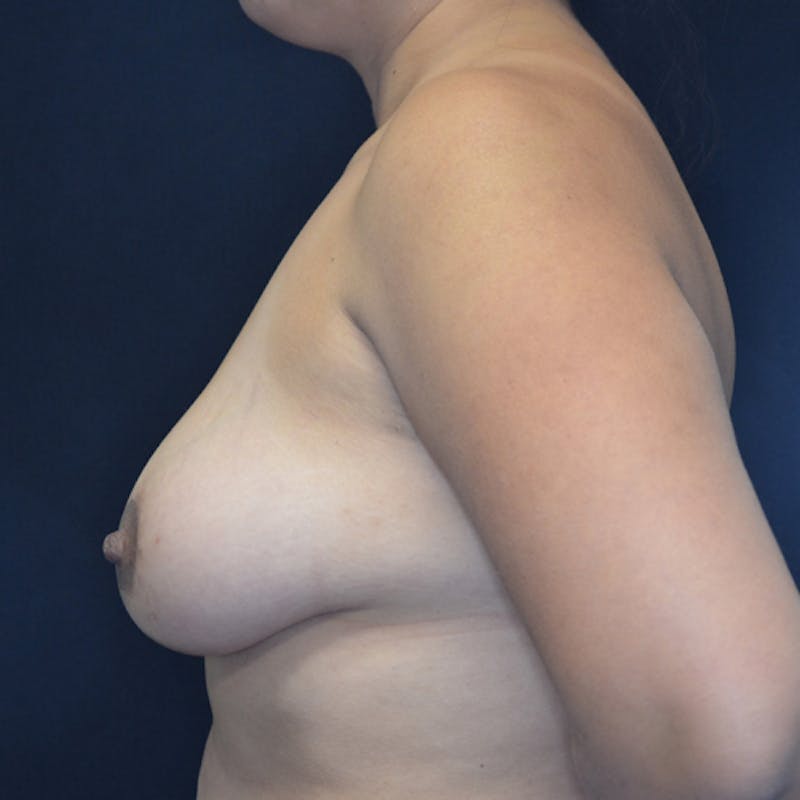 Breast Lift Before & After Gallery - Patient 114721050 - Image 10